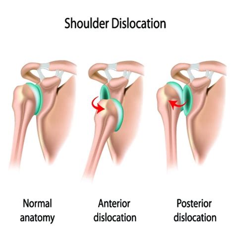 Shoulder Dislocation Treatment in Bangalore | Shoulder Surgery India