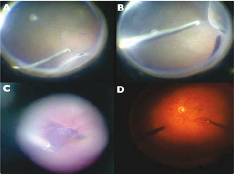 Intraoperative view of macular hole surgery submitted to ILM peeling ...