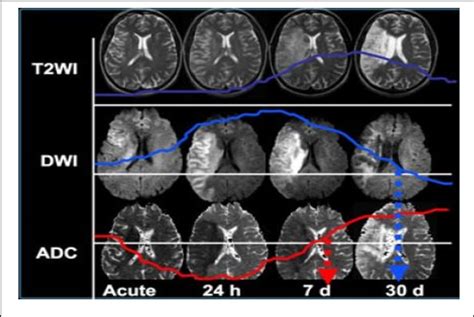 Mri Adc Sequence