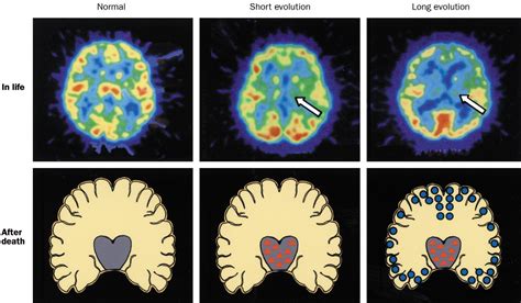 Familial and sporadic fatal insomnia - The Lancet Neurology