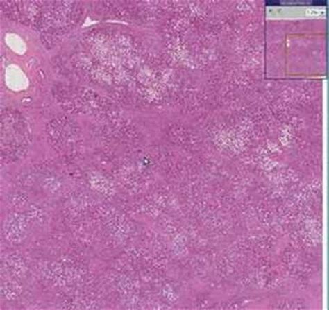 Histopathology Liver--Cirrhosis (micronodular) - YouTube