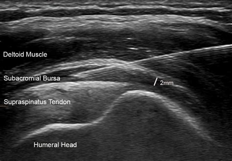 IMAGING GUIDED EUFLEXXA INJECTION FOR MANAGEMENT OF KNEE OSTEOARTHRITIS ...