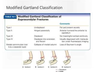 Supracondylar humerus fracture & complication for MBBS students | PPT