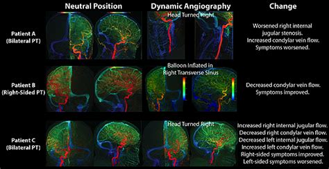 Pulsatile Tinnitus Causes and Treatments | UCSF Radiology