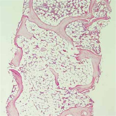 Bone marrow trephine biopsy section, aplastic anemia, showed marked... | Download Scientific Diagram