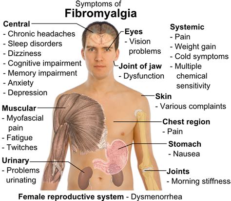 for treatment: Fibromyalgia