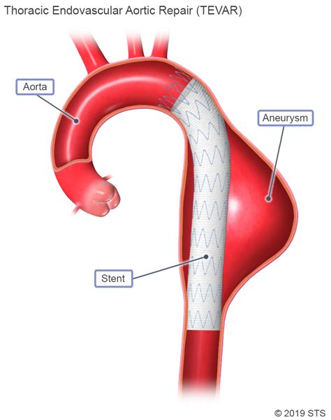 Superdrug Health Clinic: Descending Thoracic Aortic Aneurysm