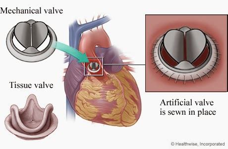 Medical Treatment Pictures-for Better Understanding: Aortic Valve Replacement Surgery: Before ...