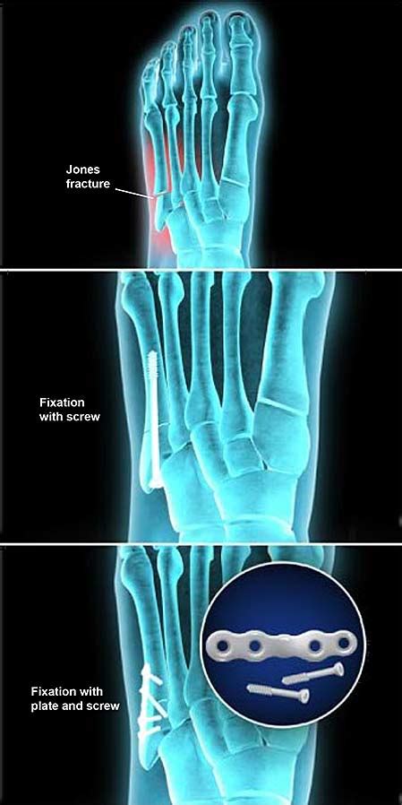 Jones Fracture Fixation (Open Reduction and Internal Fixation) | Central Coast Orthopedic ...