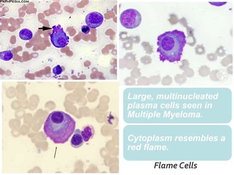 Plasma Cell Disorders | PPT