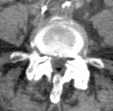 Brain and Spines: Spinal osteo-arthritis