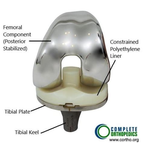 Total Knee Replacement, Knee Specialist in NY | Complete Orthopedics