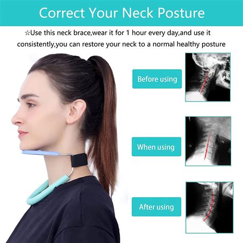 Neck Hump Corrector & Cervical Collar - Relief for Neck Pain, Support ...