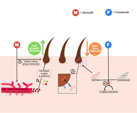Combination Topical Finasteride + Minoxidil for Hair Loss Treatment ...
