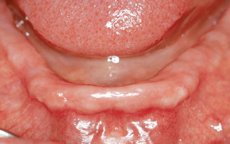 The Edentulous Maxilla and Mandible | Pocket Dentistry