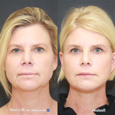 What is a Mini Facelift? | Mini face lift, Botox face, Facelift procedure