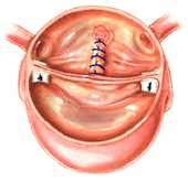 Aortic Valve Surgery: Treatment Options | Cleveland Clinic