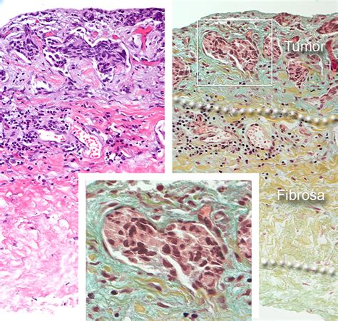 Structure of the Human Pericardium and Responses to Pathologic Processes - American College of ...