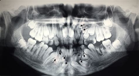 Non-syndromic multiple impacted teeth: two case reports | Biomedical ...