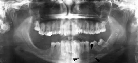 Peripheral Giant Cell Granuloma Radiograph