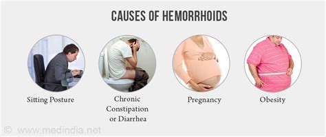 Hemorrhoids | Piles - Types, Causes, Symptoms, Diagnosis