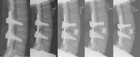 Lateral radiograms of successive steps of testing procedure: from left... | Download Scientific ...