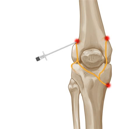 Parents Network Life: Genicular Nerve Radiofrequency Ablation