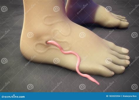 Guinea Worm Disease, Dracunculiasis Stock Illustration - Illustration of medinensis, disease ...