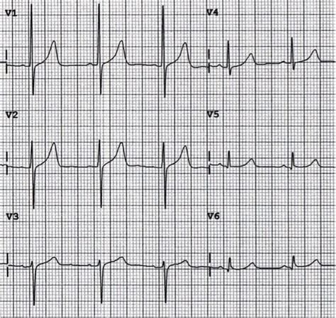 R wave • LITFL • ECG Library Basics