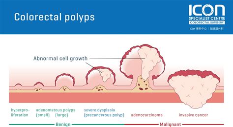 Colorectal polyps — Icon Specialist Centre