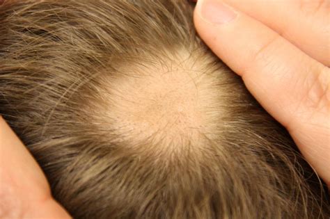 Types of Alopecia - Scarring, Androgenetic , Alopecia Areata - DHI India