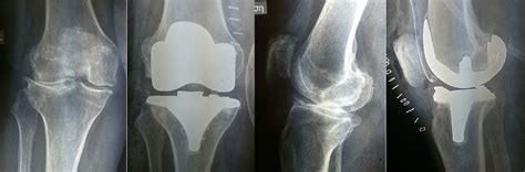 Female, 78 yrs old (Biomet-Signature) | Total knee replacement, Knee ...