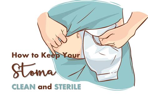 Taking Care of Your Stoma After an Ostomy | Ostomy, Stoma, Ostomy care