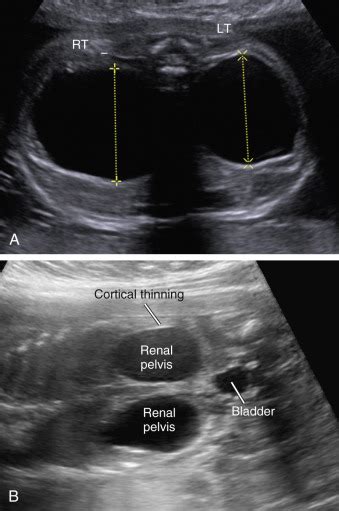 Renal Pelvis Dilatation | Radiology Key