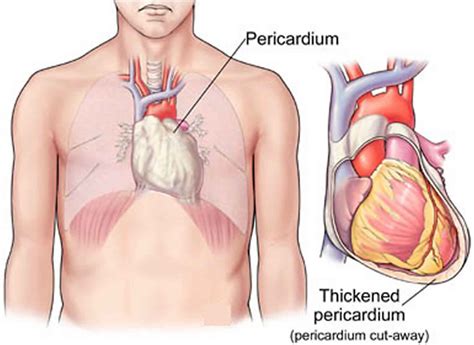 Pericardiectomy indications, procedure, complications, prognosis & long term effects