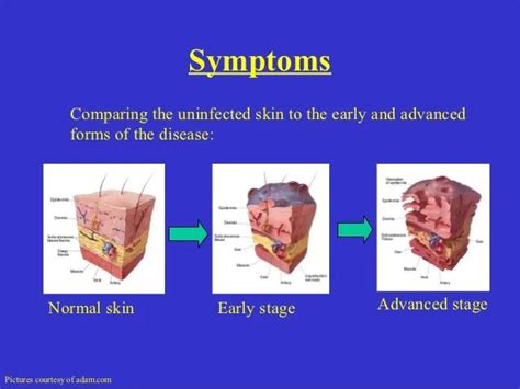 Necrotizing Fasciitis - Flesh Eating Disease | Paminaki Lovelly