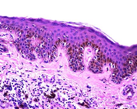 Lentigo simplex - Libre Pathology