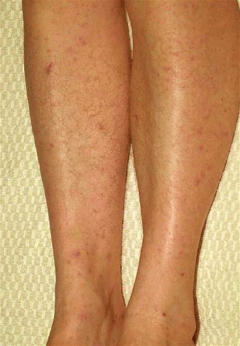 👉 Maculopapular Rash - Pictures, Causes, Treatment, Diagnosis (January 2022)