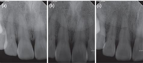 (a) The radiograph of the initial visit shows a horizontal root... | Download Scientific Diagram