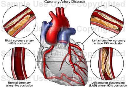 Heart Disease Drawing at GetDrawings | Free download