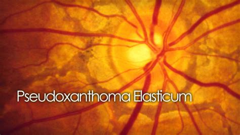 Pseudoxanthoma Elasticum (PXE) and the retina