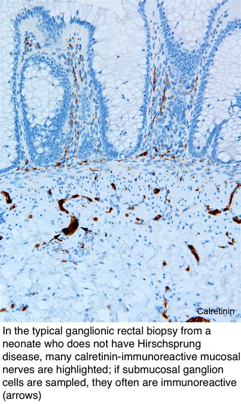 Pathology Outlines - Hirschsprung disease