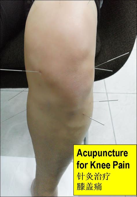 TCM News: Chinese Natural Herbs and Acupuncture for Knee Pain, Swollen Knee