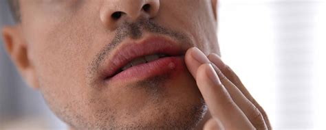 Cold sores: Causes, symptoms and treatments