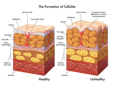 Cellulite - Médecine-esthetique