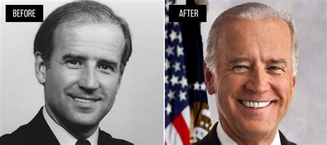 Everything About Joe Biden Hair Transplant