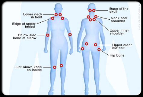 Acupuncture and Fibromyalgia: Treating the Pain