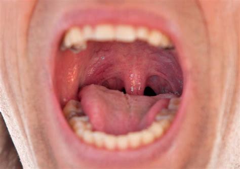 Medical News Today: Swollen uvula: Causes, symptoms, and remedies ...