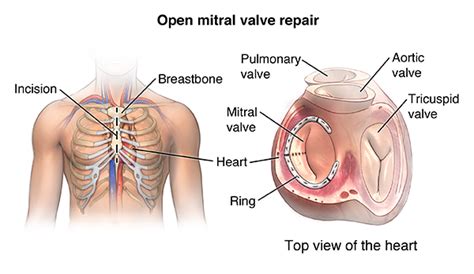 mitral valve repair recovery stories - cameron-vesco