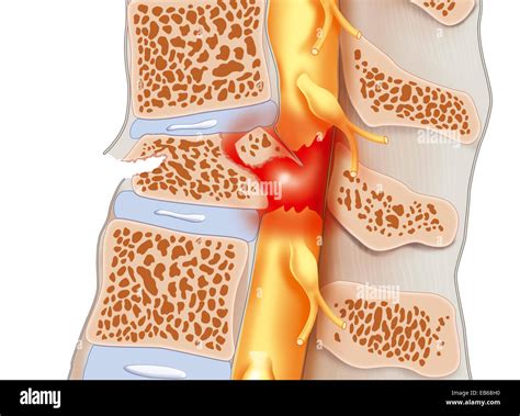 Spinal cord injury hi-res stock photography and images - Alamy